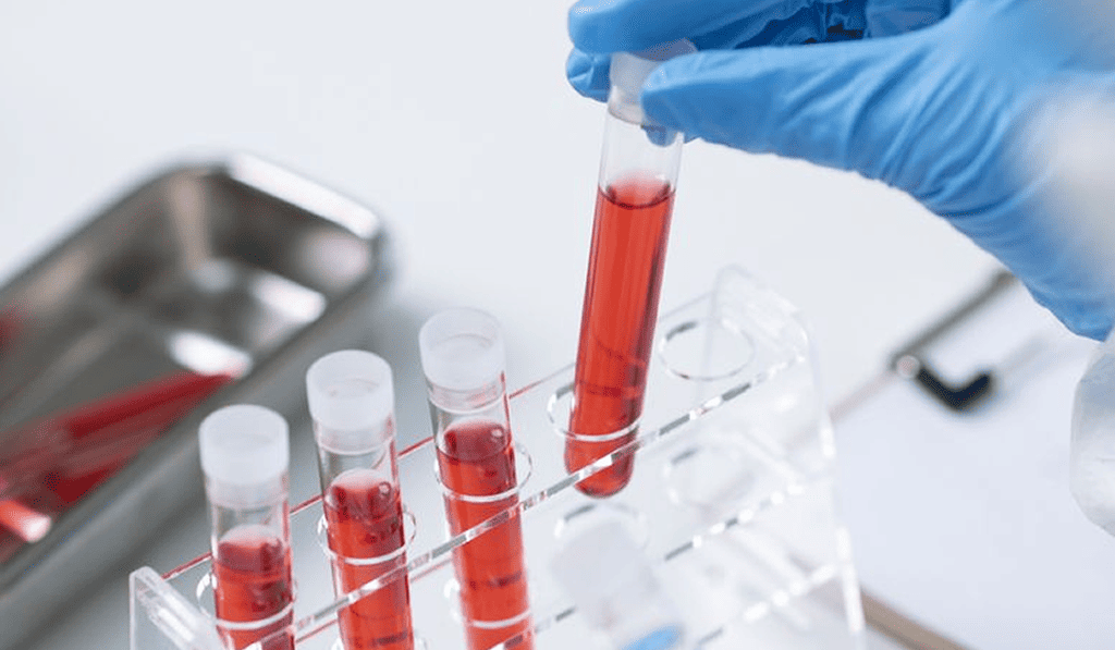 Meningitis bacteriana vs. viral: Cómo descifrar el líquido cefalorraquídeo y el riesgo según el patógeno