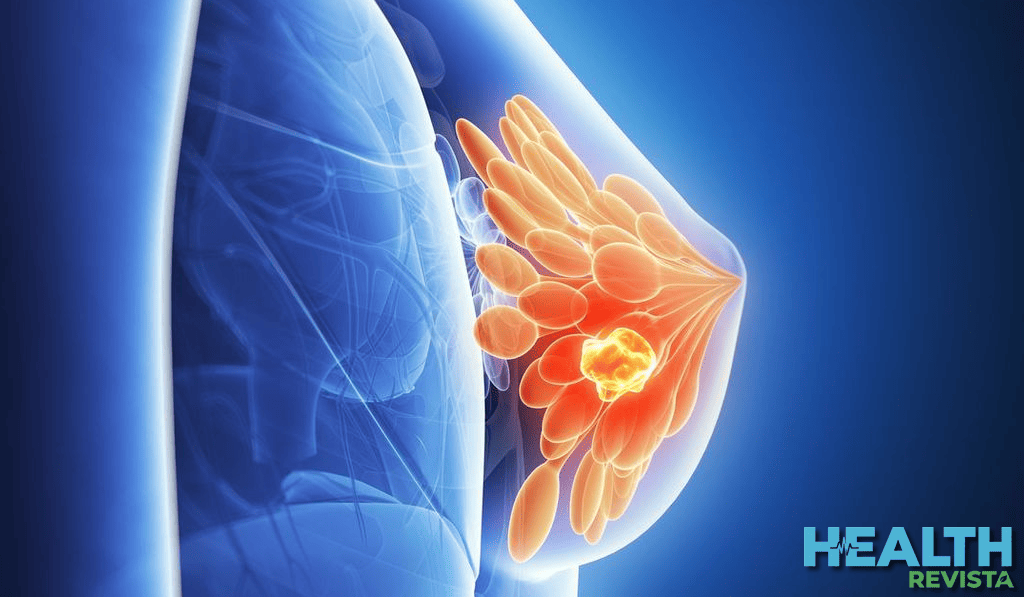 Quistes simples, fibroadenomas y calcificaciones secretoras: La anatomía detrás de un resultado benigno en la mama